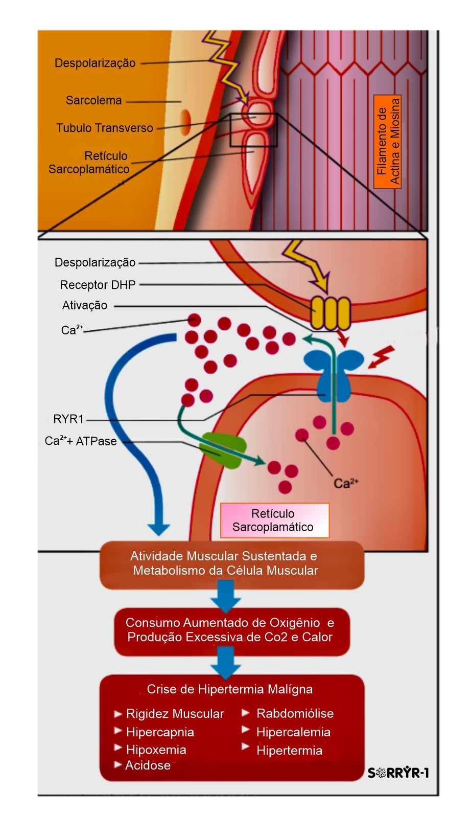 hipertermia-maligna-ponto-de-aten-o-para-os-m-dicos-anestesistas